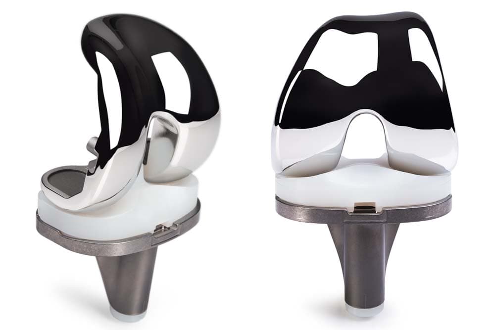 Minimally invasive knee implant components