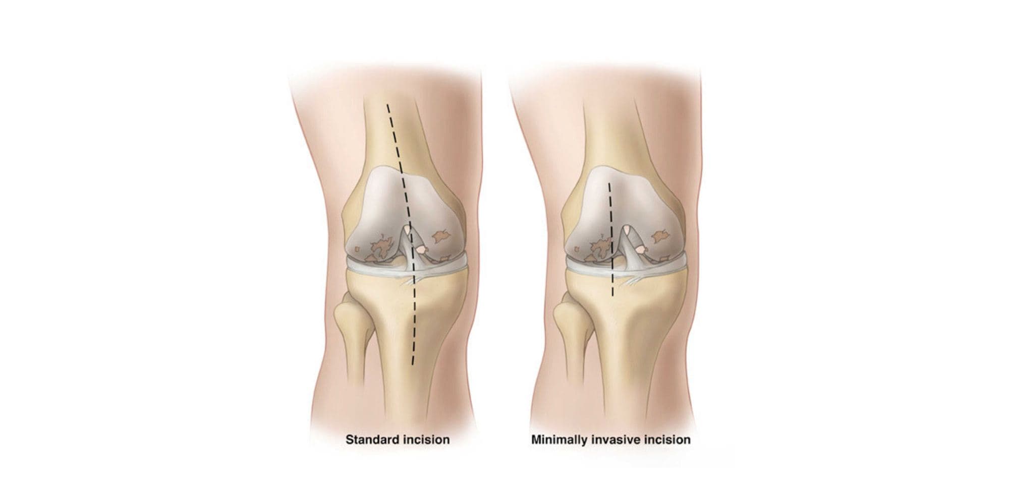Minimally invasive knee replacement surgery
